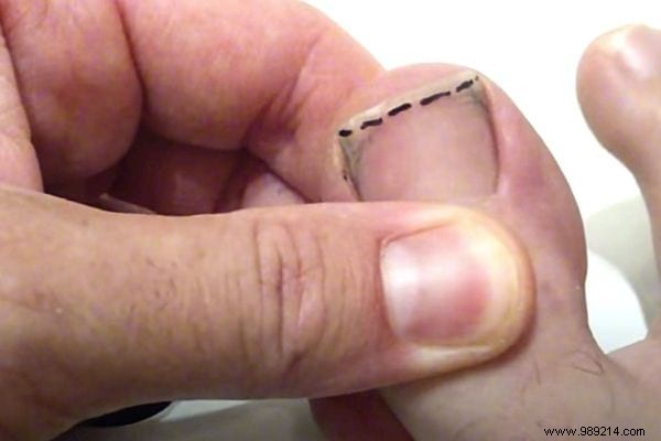 The Tip For Cutting Your Toenails (And Avoiding Ingrown Toenails). 