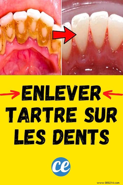 3 Amazing Tips To Remove Dental Tartar By Yourself. 