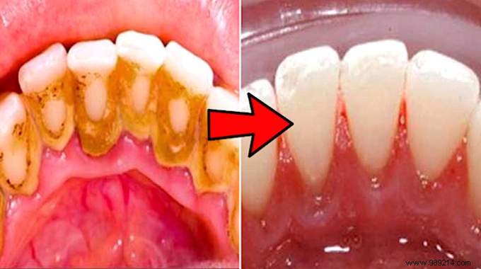 3 Amazing Tips To Remove Dental Tartar By Yourself. 