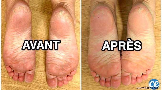 The Bicarbonate of Soda Tip for Very Soft Feet. 