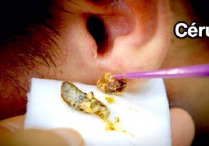 How to Remove an Earwax Blockage? The Natural &Effective Remedy. 