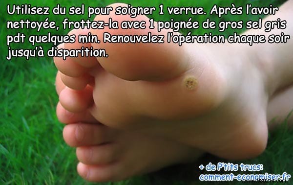 The Natural and Effective Remedy to Cure a Wart. 