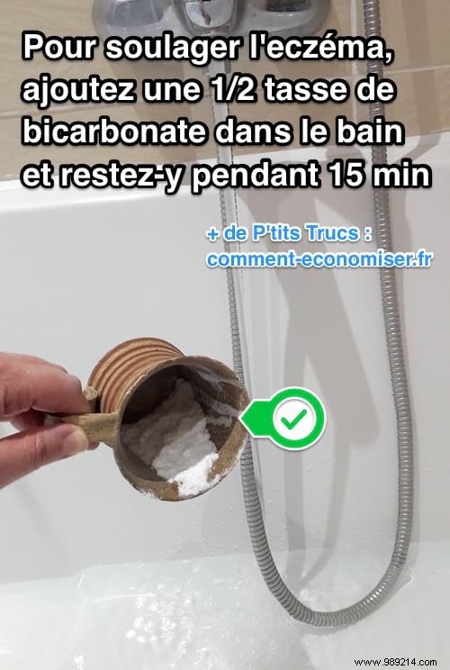 Bicarbonate:The Miracle Remedy for Eczema. 