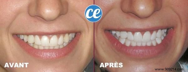 The 3 Best Remedies For Having White Teeth At A Glance. 