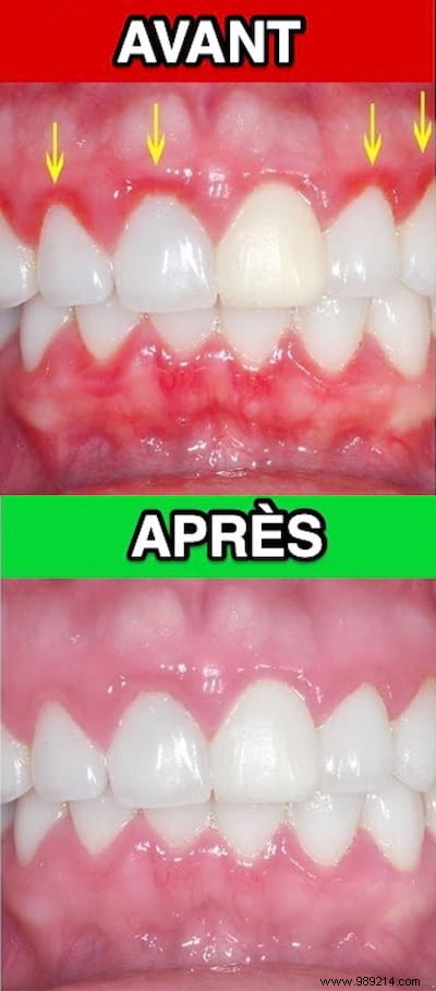 Gingivitis:The Natural And Effective Remedy To Quickly Calm Pain. 