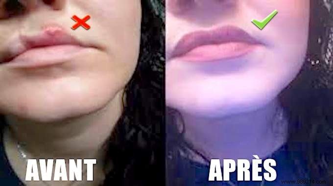 Herpes on the Lip:The Magic Remedy to Stop It Net! 