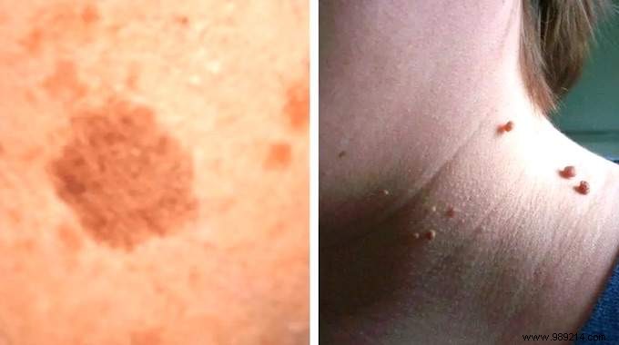 8 Natural Remedies For Warts, Skin Tags And Age Spots. 