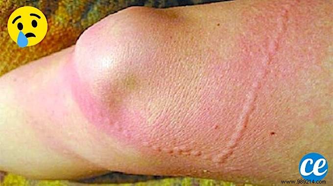 Jellyfish Stings:Here s How to Stop the Pain IMMEDIATELY! 