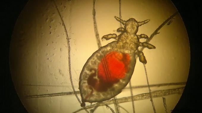 How to Fight Lice Naturally? My Home Recipe. 