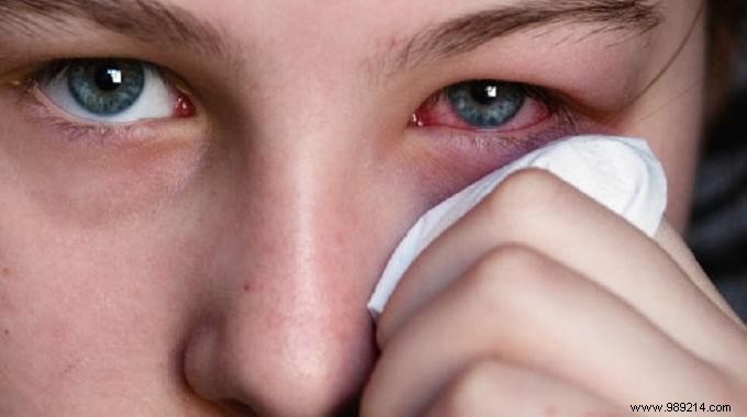 Probably the Best Natural Conjunctivitis Remedy. 