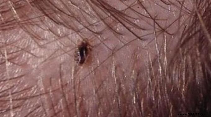 The Natural and Effective Remedy to Eliminate Lice. 