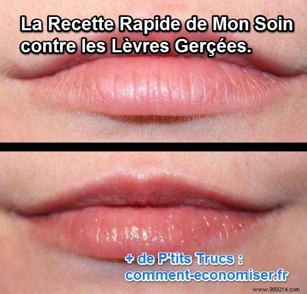 The Fast and Natural Remedy for Chapped Lips. 