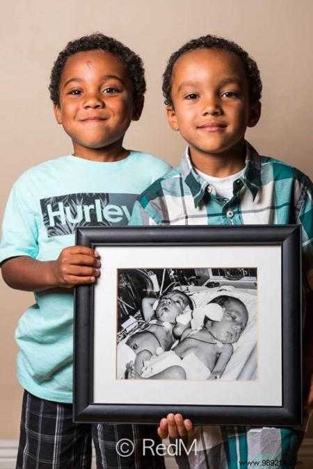 17 Photos of Premature Babies Who Hold Photo Two When They Were Babies. 