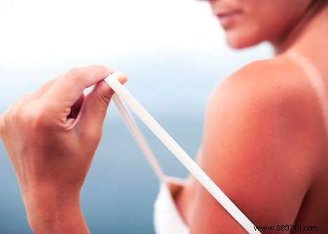 How does the sun burn your skin? 