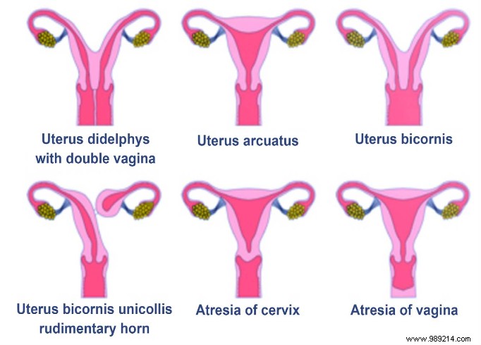 A teenager discovers that her body has two vaginas! 