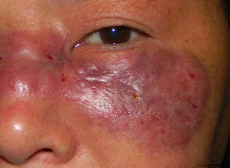 Covid-19:Severe  Black Fungus  Infection Appears in Patients in India 