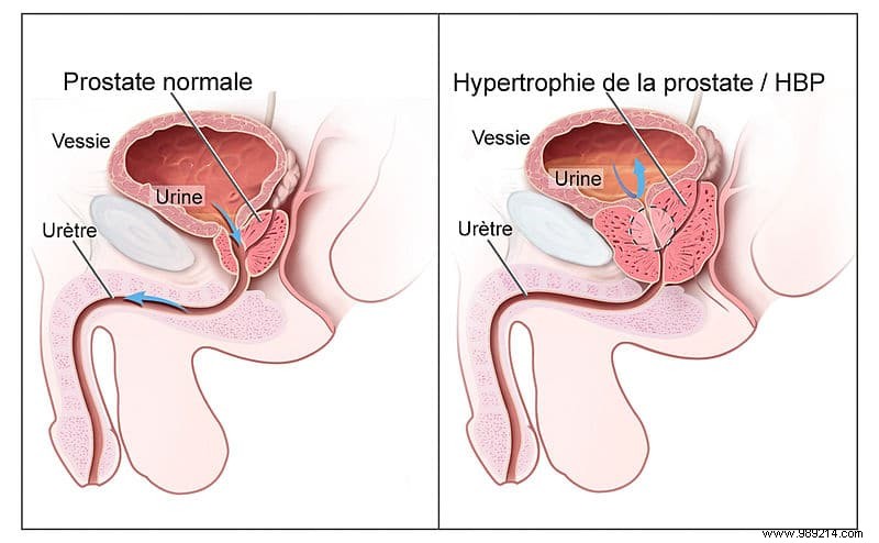 A major discovery for the treatment of prostate cancer 