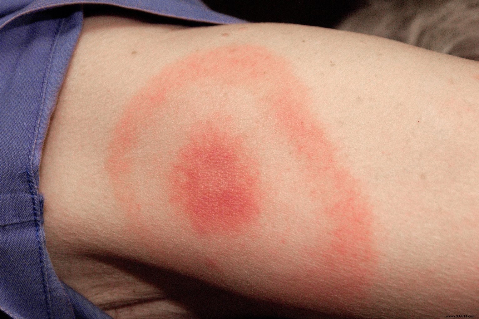 Lyme disease has already affected 14% of the world s population. 